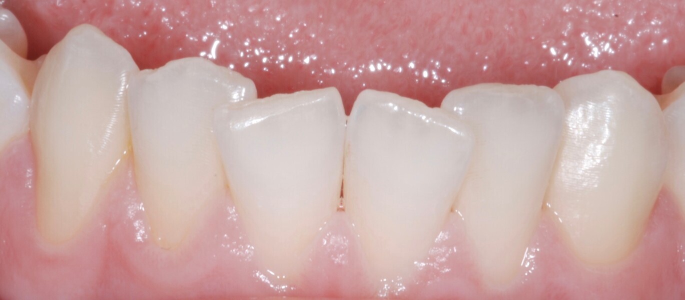 Fig. 39: Close-up intra-oral mandibular frontal view before treatment.