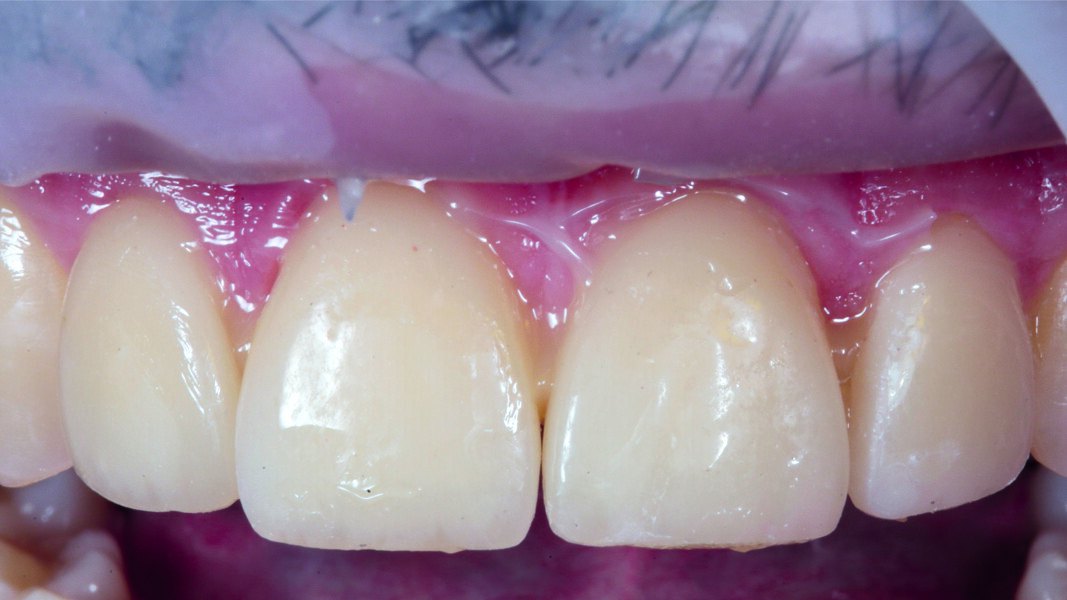 Fig. 9: Veneer fit test.