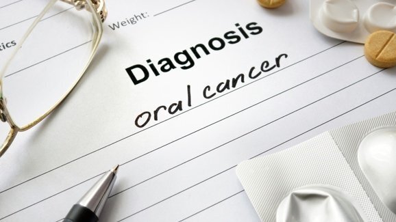 Aumento do câncer oral nos EUA