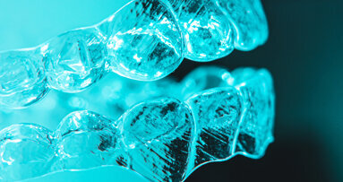 Global clear aligner market: The stars are aligned Global clear aligner market: The stars are aligned