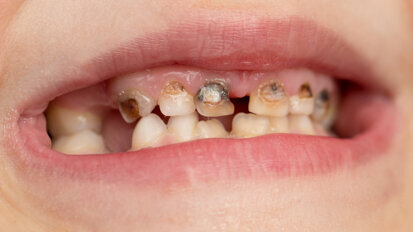 Scotland’s poorest paying the price for dental crisis, says British Dental Association