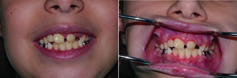 Fig. 16 (a & b). Final result. The anterior crossbite of teeth 11 and 21 had been corrected 4 months following surgery. There is a midline diastema, which is a normal phenomena at this stage and will subsequently close. The patient may later benefit by a 2X4 fixed orthodontic appliance to straighten both 11 & 21, but we will wait for the eruption of 22.