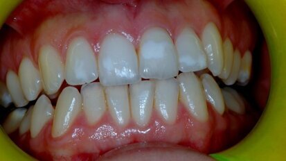 Manifestazioni orali nel paziente celiaco