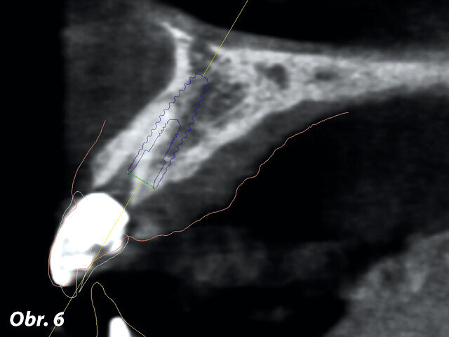 Obr. 6: Plánování ideální pozice implantátu