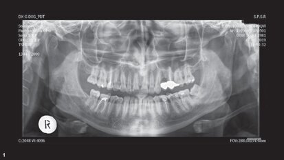 伴复杂根管系统的左侧上颌第一磨牙的 牙髓治疗