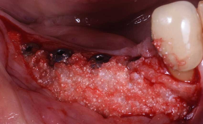 Fig. 6 - Innesto osseo.