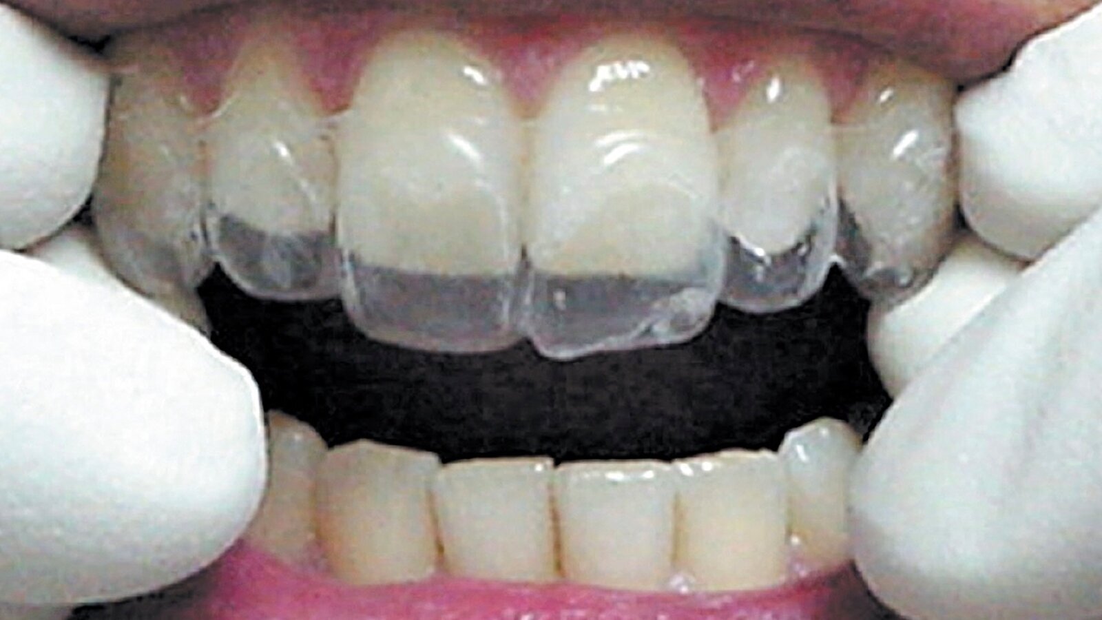 Estética y blanqueamiento dental en la era digital  (Capítulo 4)