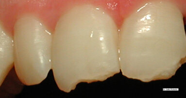 Implantologia nei settori estetici mediante l’uso di abutment personalizzabili