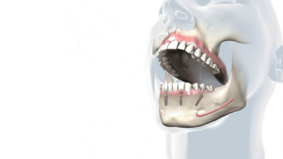 Novi materijali kao izbor pri izradu implantnih rekonstrukcija