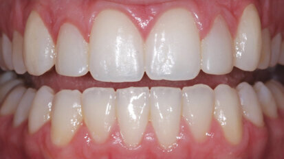 Alternative treatment options with nanohybrid composites Alternative treatment options with nanohybrid composites