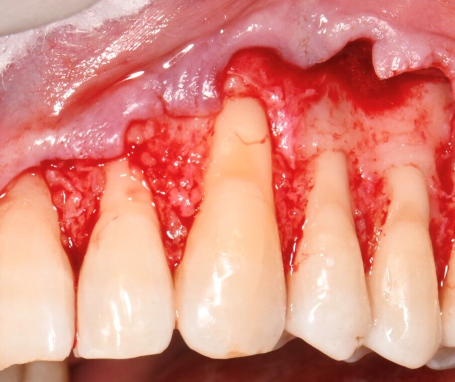 Fig. 4 - Dettaglio del lembo a busta ottenuto mediante scollamento dai piani sottostanti con tecnica a spessore misto (parziale -totale-parziale).
