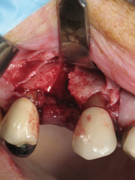 Fig. 2 : Perte osseuse verticale de la table vestibulaire. 