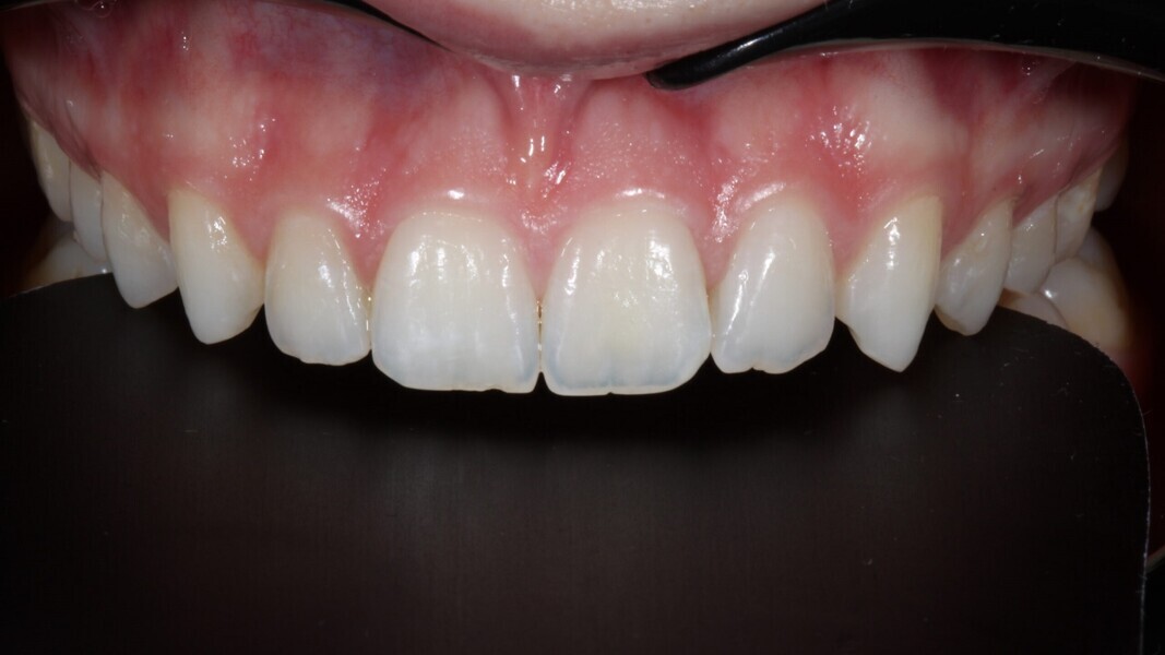 Fig. 2: Buccaal aanzicht. Anatomie van de voortanden.