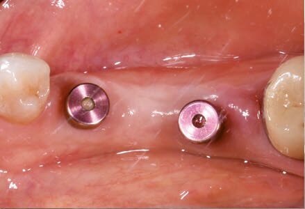 Fig. 14 - Visione a 6 mesi dei tessuti molli perimplantari.