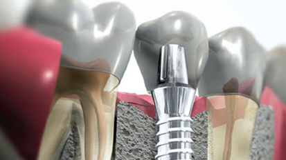 Cursos de implantología en la Cayetano Heredia
