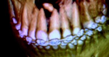 Cone beam CT-based imaging for evaluation of supernumeraries