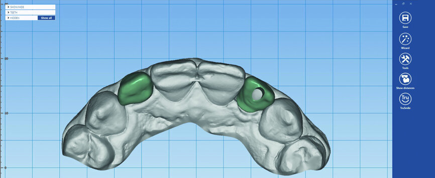 Fig. 16: The final restorations were designed in Planmeca PlanCAD Premium.