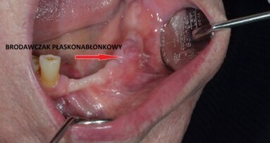 Czujność onkologiczna w leczeniu implantoprotetycznym – wirus brodawczaka ludzkiego HPV