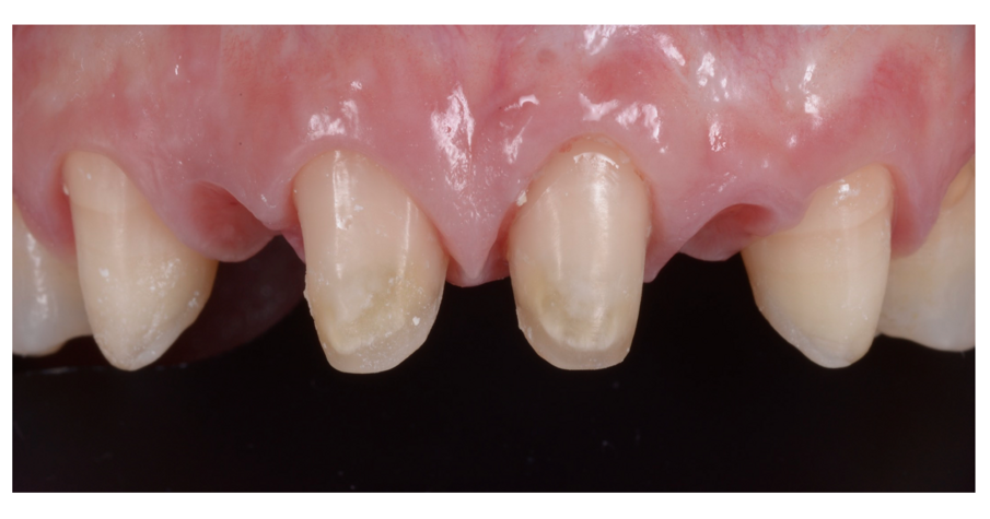 Fig. 17_Ponte provvisorio appena rimosso.