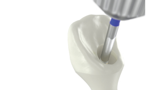 Nobel Biocare – angulated screw channel solutions