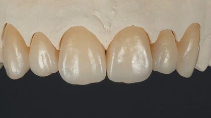 Cementation of zirconia