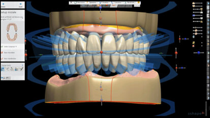 Trattamenti con dentizione terminale in età pre-geriatrica: proposta di un protocollo clinico di Day Dentistry