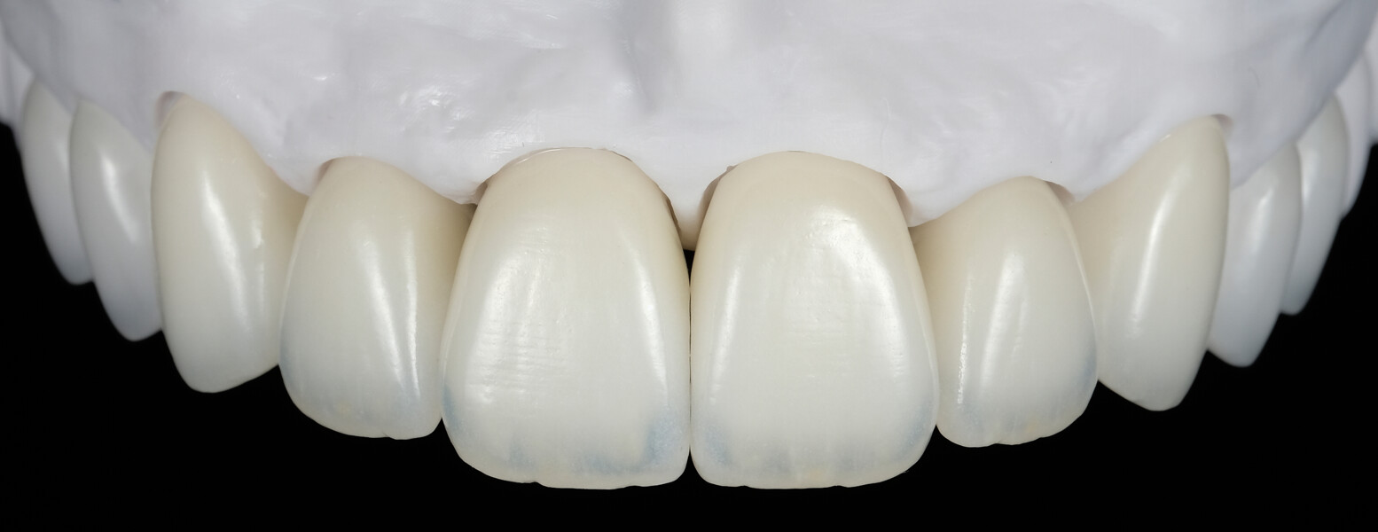 Fig. 26: Verification of passive fit and interproximal contact areas of the maxillary restorations on the model.