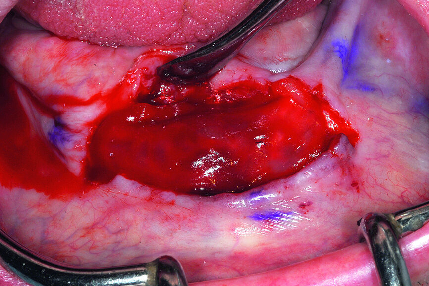 Fig. 18b: A resorbable calcium apatite bone grafting material was used to fill voids and cover the implant—followed by applications of platelet-rich fibrin (PRF).