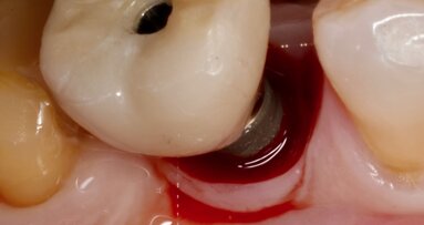 Interacción entre factores protésicos y sistémicos en la periimplantitis 