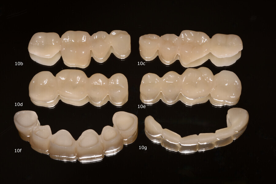 Figs. 10b–g: Provisional restorations after post-processing and high-gloss polishing. Posterior (b–e) and anterior segments (f & g).