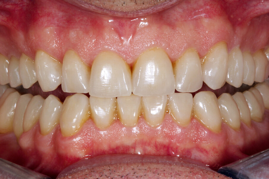Fig. 21: New teeth with abrasion facets and cracks that suit bruxism patients. Stability, function and inconspicuous integration of the restorations were
the objectives of our work.