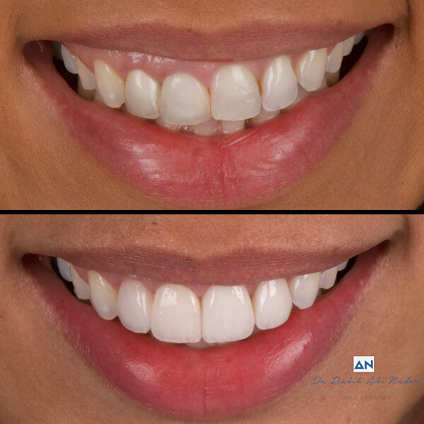 Figs. 15a & b: Pre-op (a) and post-op clinical views (b) showing an aesthetic result and healthy periodontal tissue. 