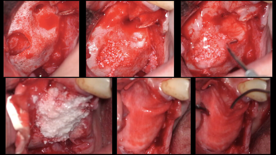 Fig. 5 - Applicazione stratificata di Regenfast durante la tecnica GBR.