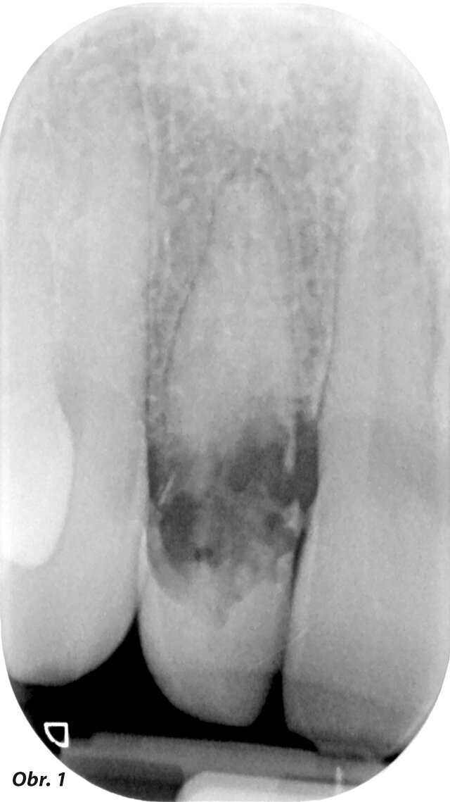 Obr. 1: RTG snímek zobrazuje vnitřní resorpci maxilárního pravého laterálního řezáku