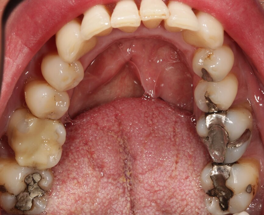 Fig. 2b: The patient desired replacement of the large-surface amalgam fillings in the upper (a) and lower jaw (b) with full-ceramic restorations.