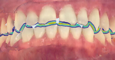 Smile Makeover pomocí fóliového ortodontického aparátu a kompozitních dostaveb