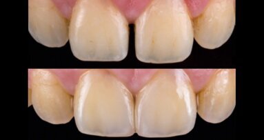 Restauración no invasiva con microcarilla de cerámica híbrida