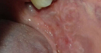 Allergie da contatto della mucosa orale