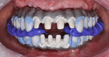 Algorytmy postępowania dla wykonywania indywidualnych rozwiązań protetycznych – cz. II: Suprastruktury przykręcane