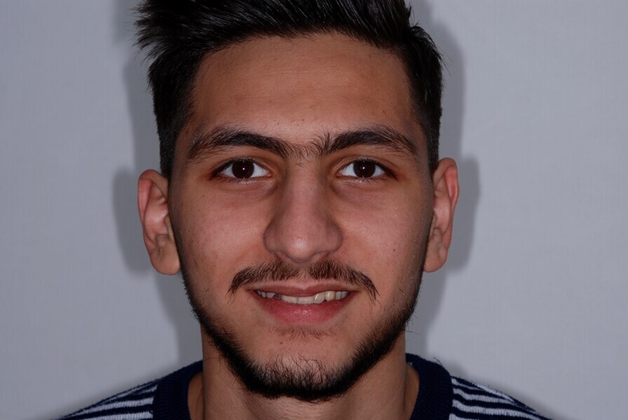 Fig. 23: Full-face frontal view before treatment.