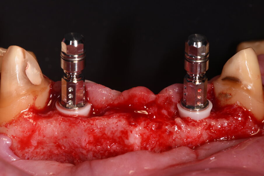 Fig. 21_Il posizionamento non prevede l’uso della dima e in quest’immagine si evidenzia il livello d’inserimento che ha tenuto presente il livello crestale palatale, i mounter evidenziano il parallelismo ottenuto grazie al meticoloso lavoro sommato alla conoscenza della tecnica chirurgica.