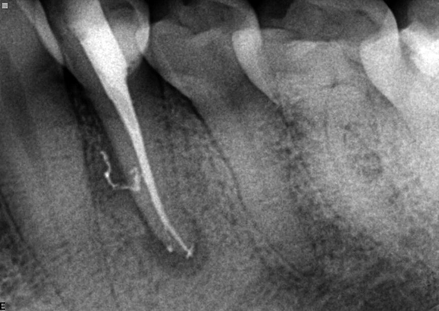 Fig. 3: A necrotic/infected case: Lower premolar of the patient complaining of dull and pulsating pain. The infection was not limited to the apical part, but was also located in the lateral mid-root section. Postoperative X-ray shows a 3-D sealing of the apical area with its anastomosis and of the lateral and accessory canals in mid root.
