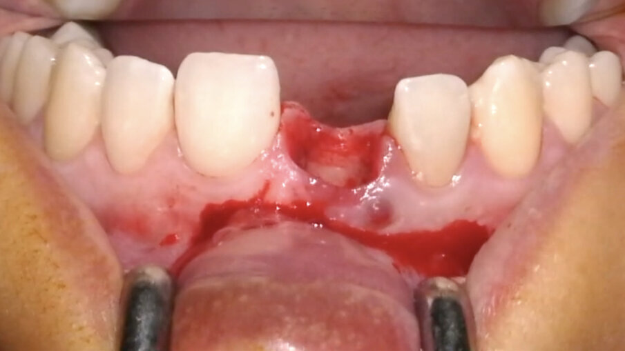Fig. 13_Alveolo integro e tessuti molli non incisi.