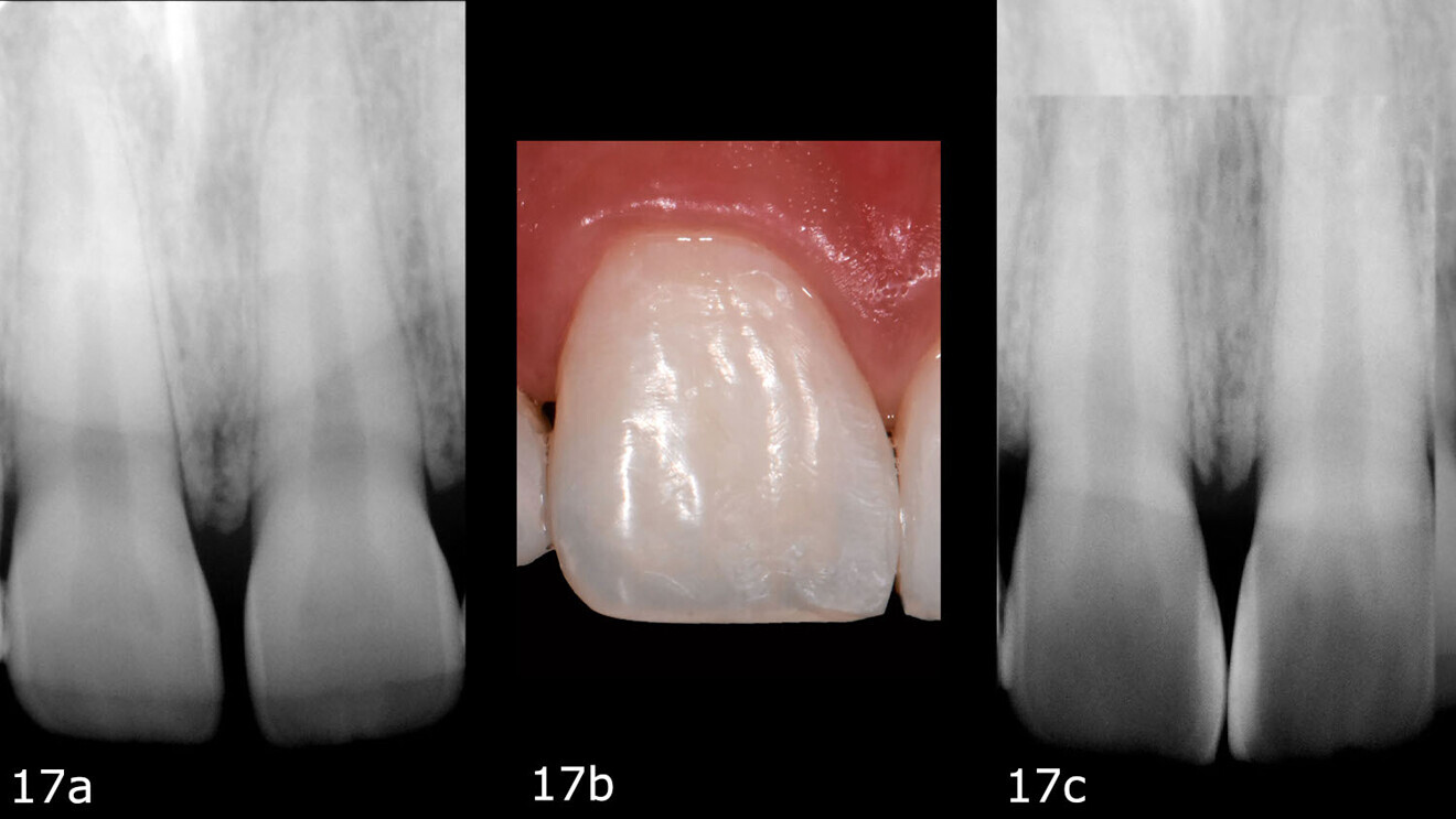 Figs. 17a–c: Pre-op (a) and post-op radiographs (c). Post-op photograph (b).