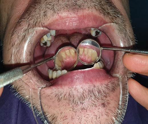 Sl. 1.2: Pacijent A, kontrola nakon mesec dana od prelaska na bezdimni duvanski proizvod