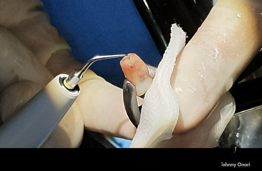  Figg. 5a-5d - Chirurgia apicale. Retro-preparazione con punte ad ultrasuoni (a & b) e retro-otturazione con CeraPutty (Meta Biomed) (c & d).