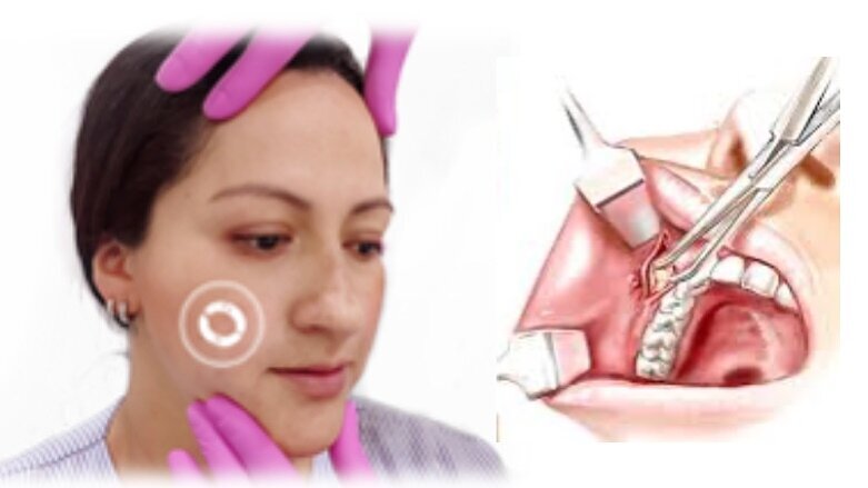 Datos importantes y riesgos de la bichectomía