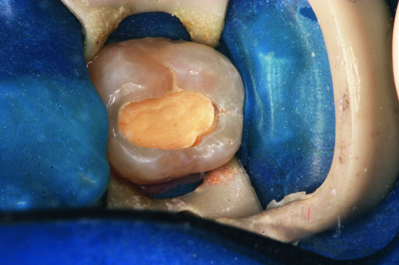 Fig. 4 : On retire Biodentine sur 2 mm.