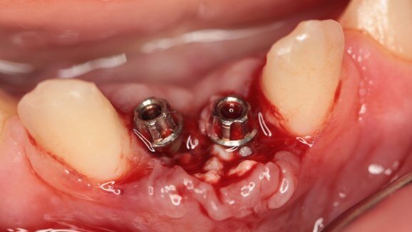 Leczenie implantoprotetyczne w przebiegu dysplazji ektodermalnej – 5-letnie obserwacje