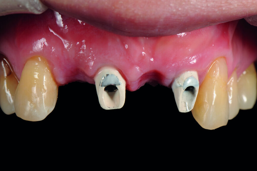 Fig. 17: Finishing of the reshaping of the gingiva.